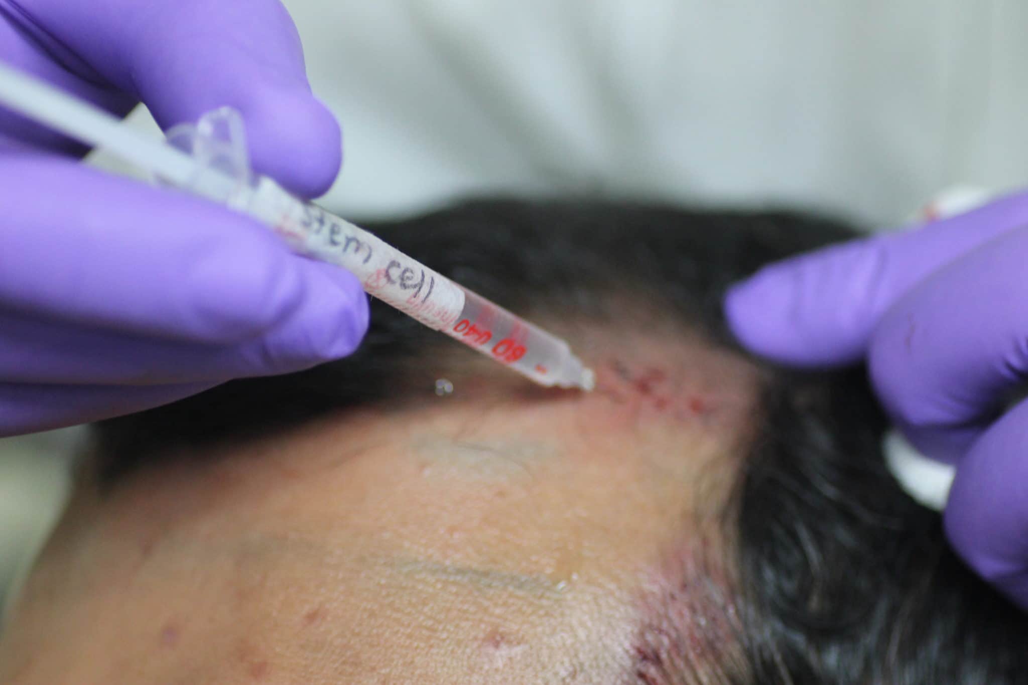 Dr. Nigam Photos  The End of Hair Loss and Balding by 2020