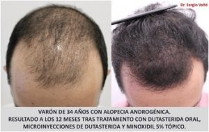 Dutasteride Archives | Hair Loss Cure 2020