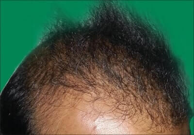 case 8 FUE 2612 grafts 9 months result FUE hair transplant Thailand